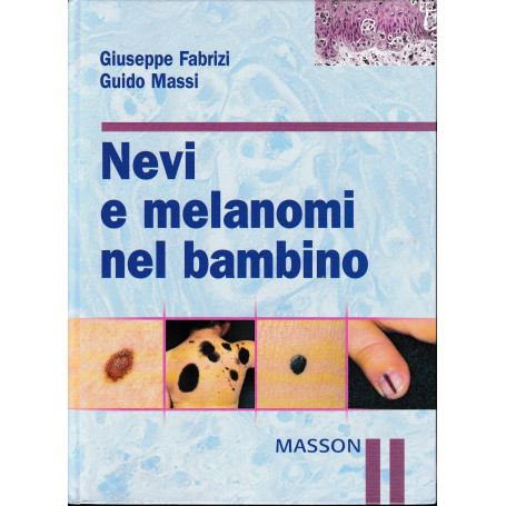 Nevi e melanomi nel bambino